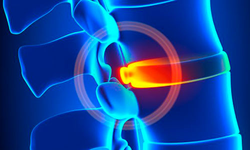 Протрузія дисків